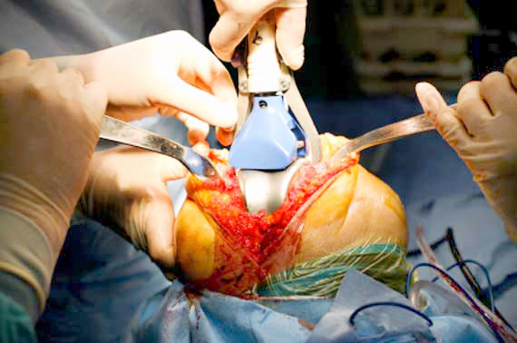knee-replacement-surgery