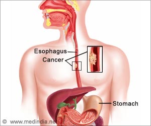esophageal-cancer
