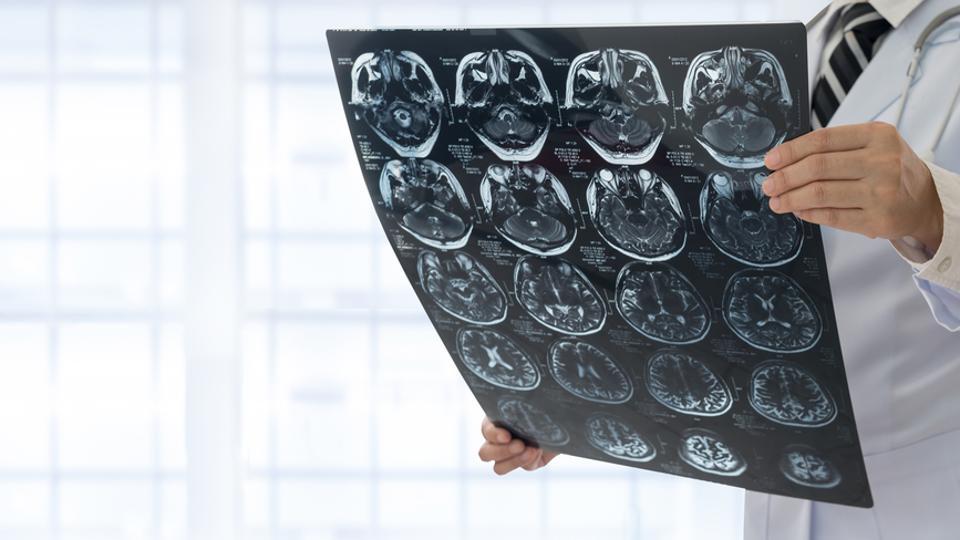 MRI scans may spot HIV lingering in brain: study MRI scans may spot HIV lingering in brain: study
