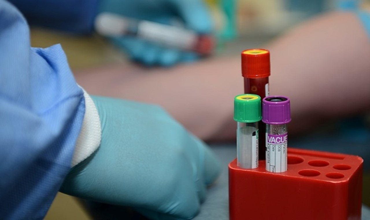 Novel Blood Test May Aid Ovarian Cancer Diagnosis Study Jammu