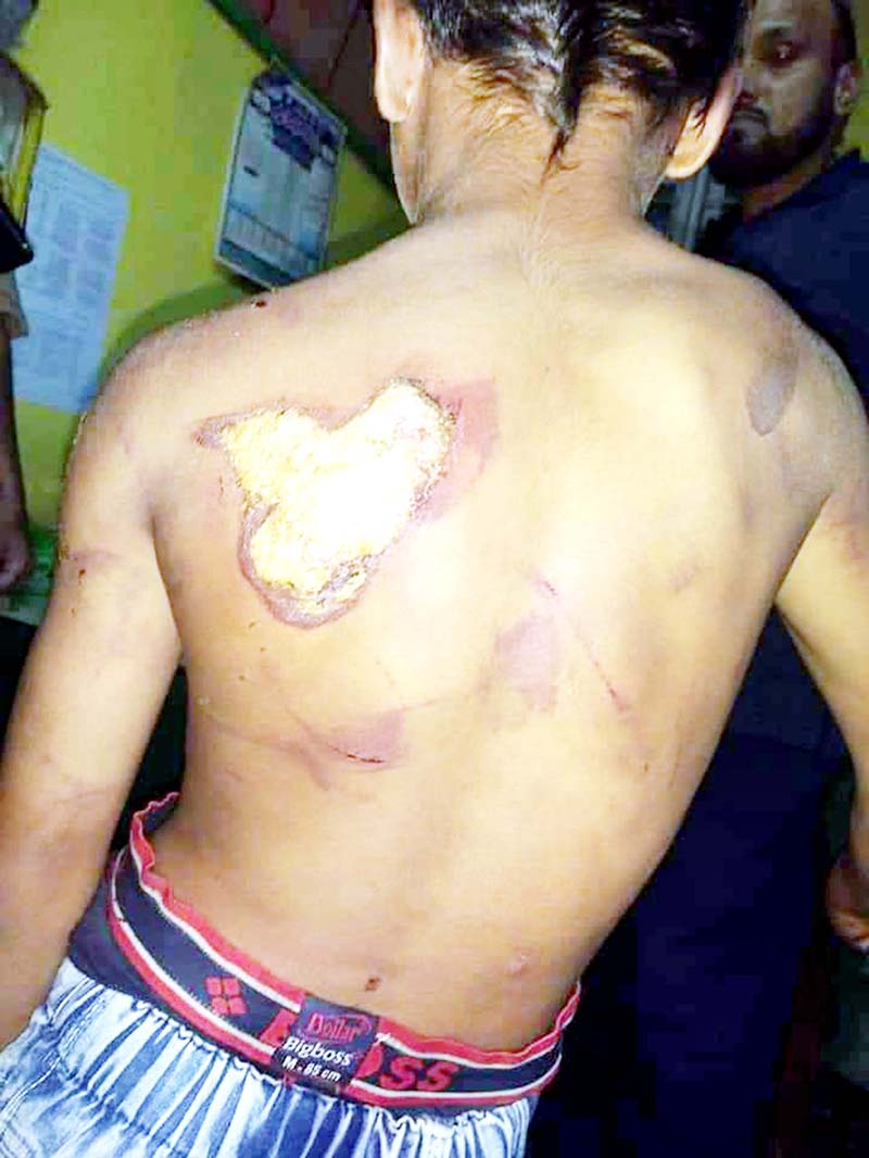 9-year-old domestic servant showing hot iron burns given by his master in Rajouri. -Excelsior/Bhat 9-year-old domestic servant showing hot iron burns given by his master in Rajouri. -Excelsior/Bhat