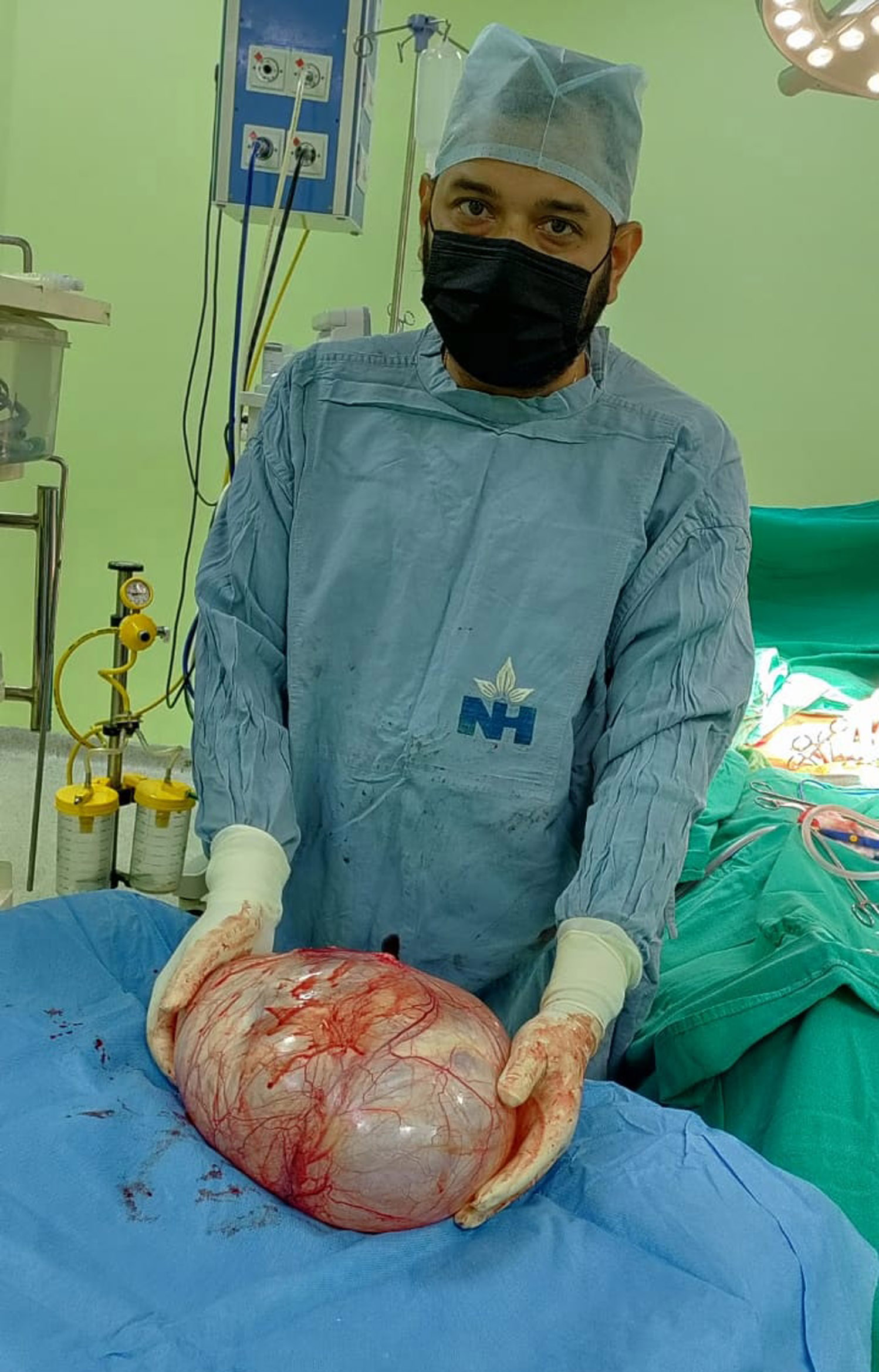 A doctor showing a massive tumor removed from abdomen of a patient at Narayana Superspeciality Hospital, Katra. A doctor showing a massive tumor removed from abdomen of a patient at Narayana Superspeciality Hospital, Katra.
