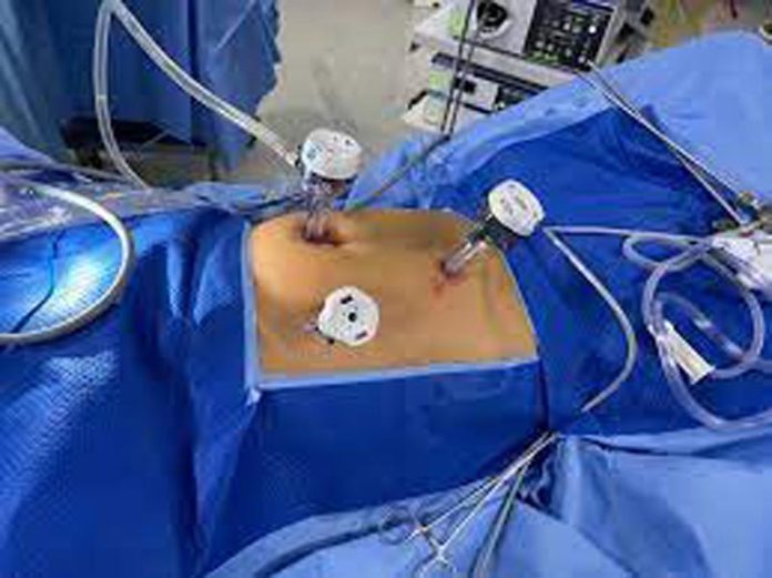 Laparoscopic right extended colectomy performed at Ankur Maitrika Hospital