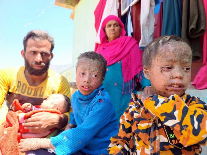 Children with rare disease and their parents in Bhaderwah on Wednesday. -Excelsior/Tilak Raj