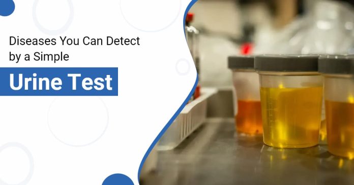 Top 5 Diseases You Can Detect by a Simple Urine Test Top 5 Diseases You Can Detect by a Simple Urine Test