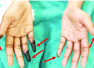 Protecting hands in cold and snow