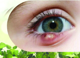 Homoeopathic Treatment for Rheumatic eye