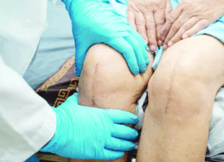 The Era of Uncemented Knee Replacement