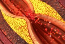 Even lower levels of artery-clogging plaque may cause heart attack risk in women, finds study