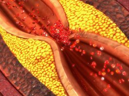 Even lower levels of artery-clogging plaque may cause heart attack risk in women, finds study