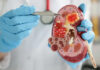 Study links chronic kidney disease with cognitive impairment