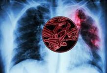 New TB vaccines safe but may not protect against all forms of infection: Phase-3 study