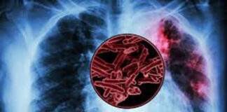 Eliminating undernutrition could prevent up to 2.3 million TB cases globally: Study