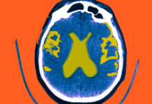 Changes in body fat due to obesity can contribute to Alzheimer’s disease: Study